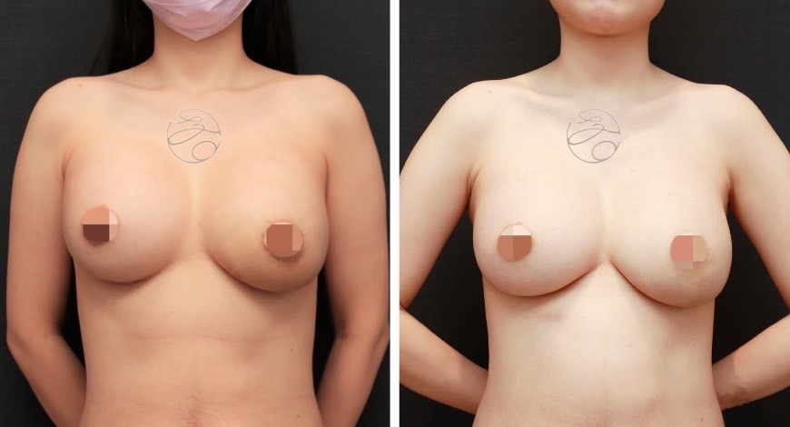 提乳手術案例三