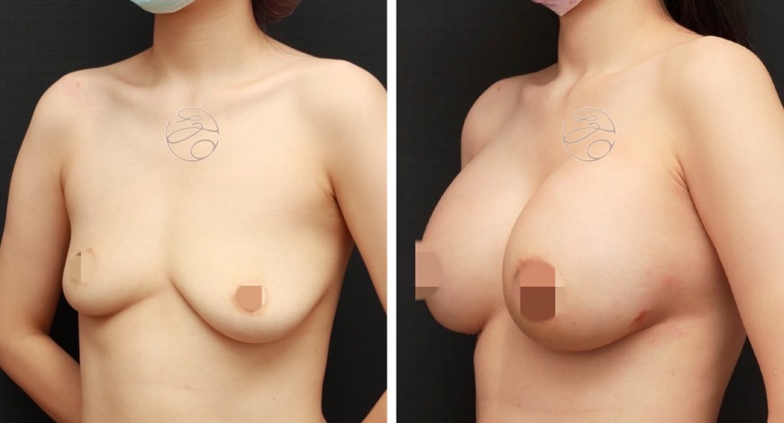 提乳手術案例二