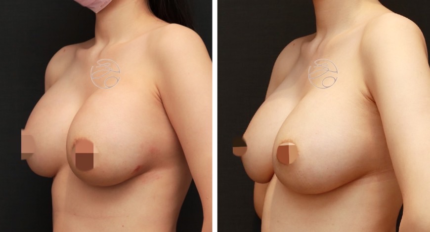 提乳手術案例四