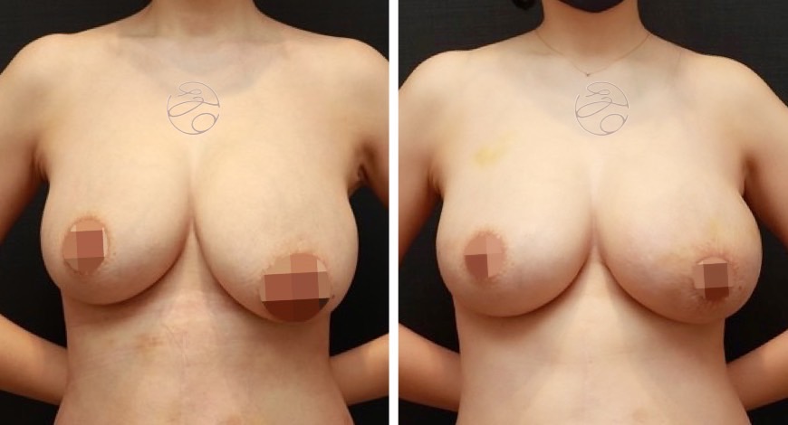 提乳手術案例照3