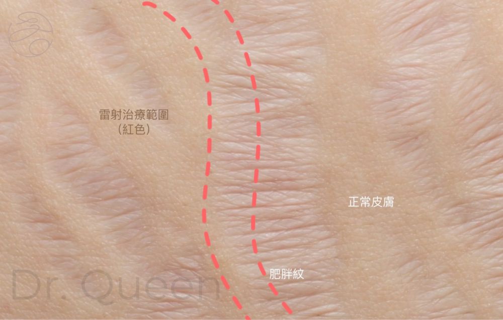 雷射治療前的肥胖紋-治療範圍
