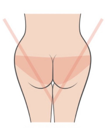 巴西提臀手術-V形臀矯正