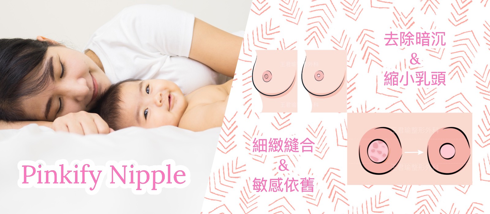 乳頭整形手術示意圖