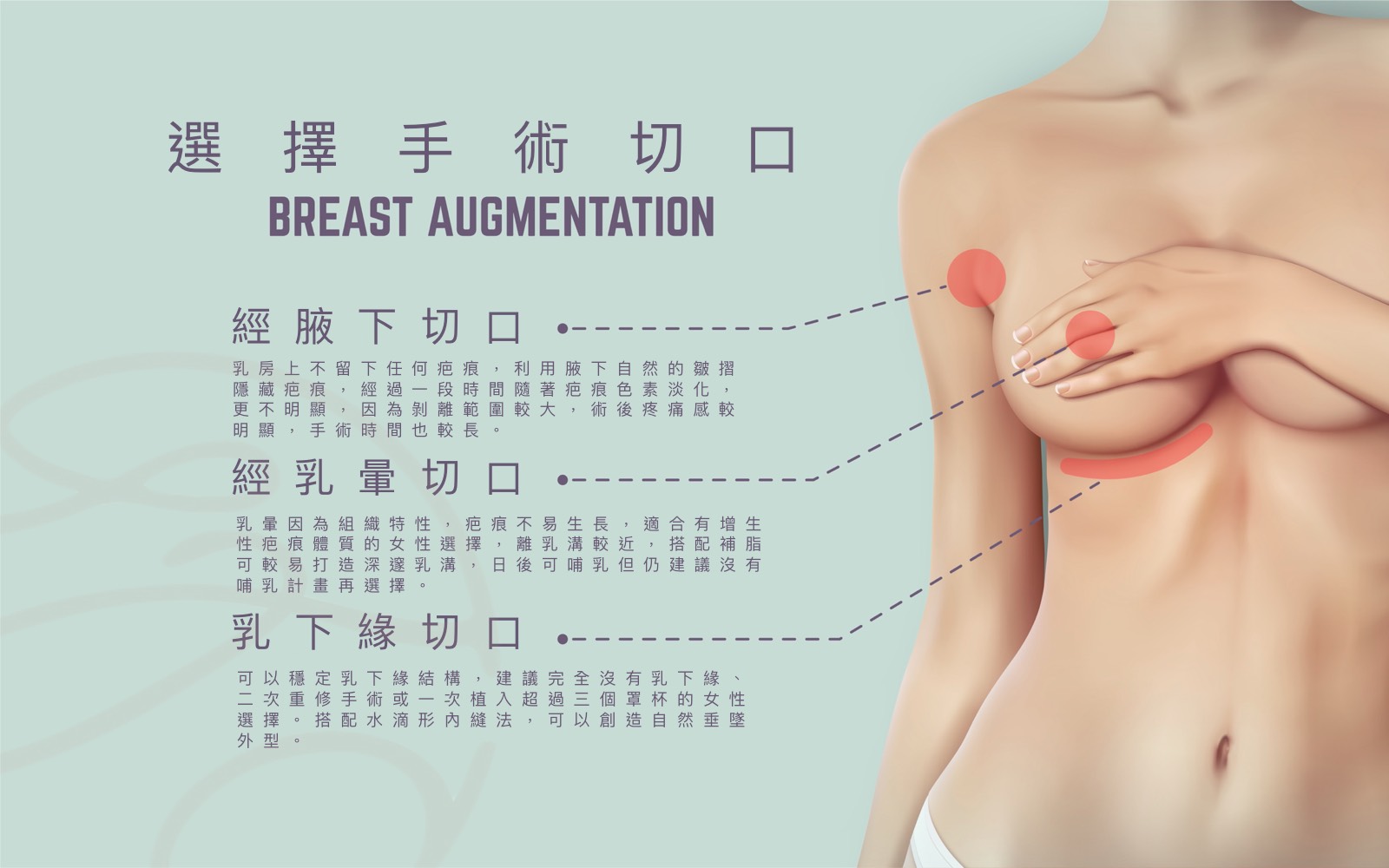 隆乳切口介紹解析圖片