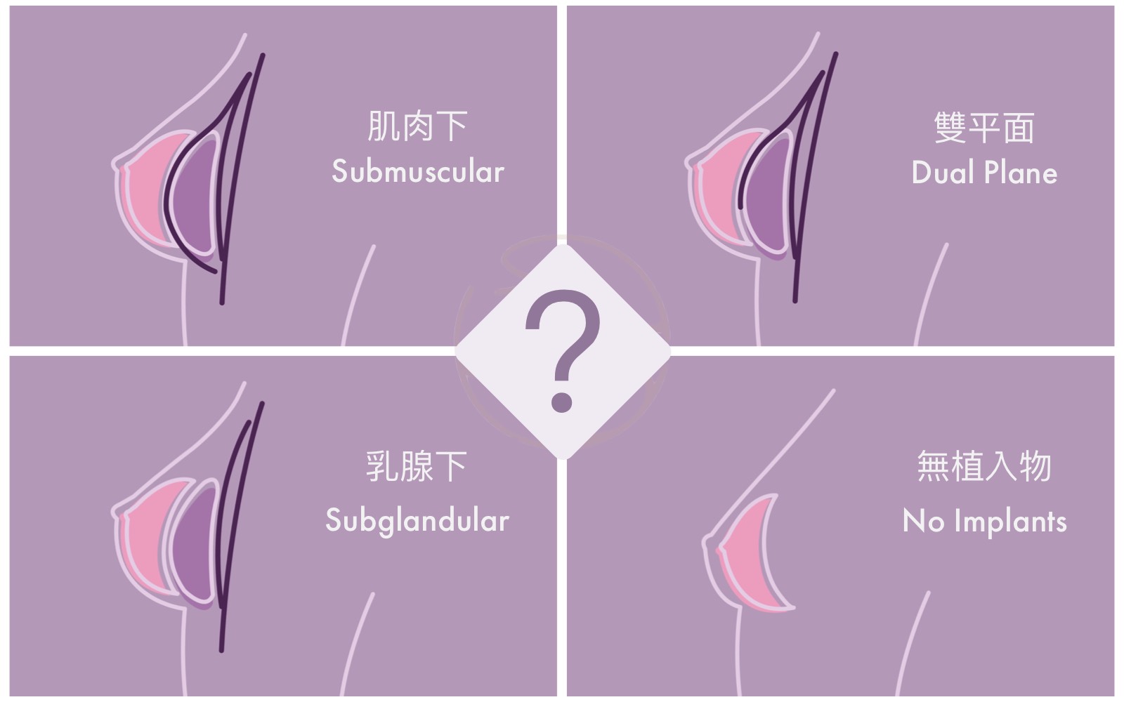 隆乳解剖層面解析圖片