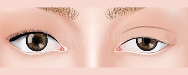 眼瞼肌無力/單邊眼皮下垂示意圖
