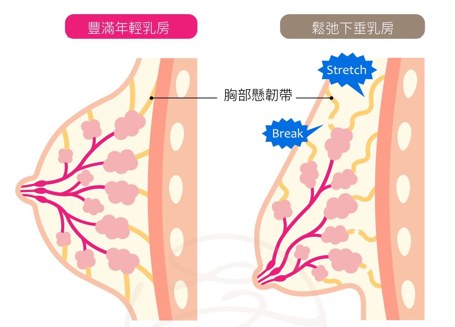 乳房下垂成因比較圖