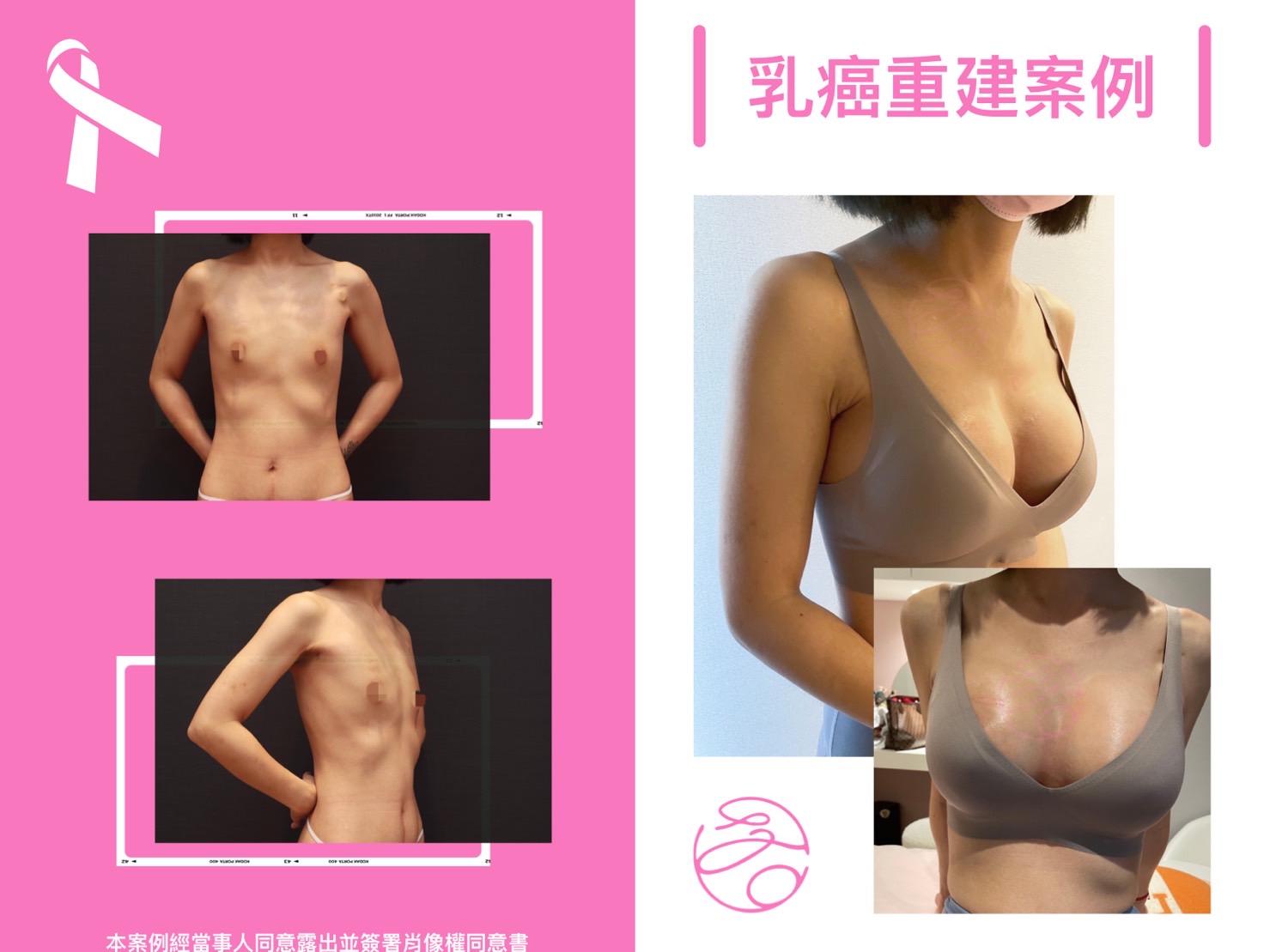 乳癌重建案例術前術後比對照片-王君瑜整形外科