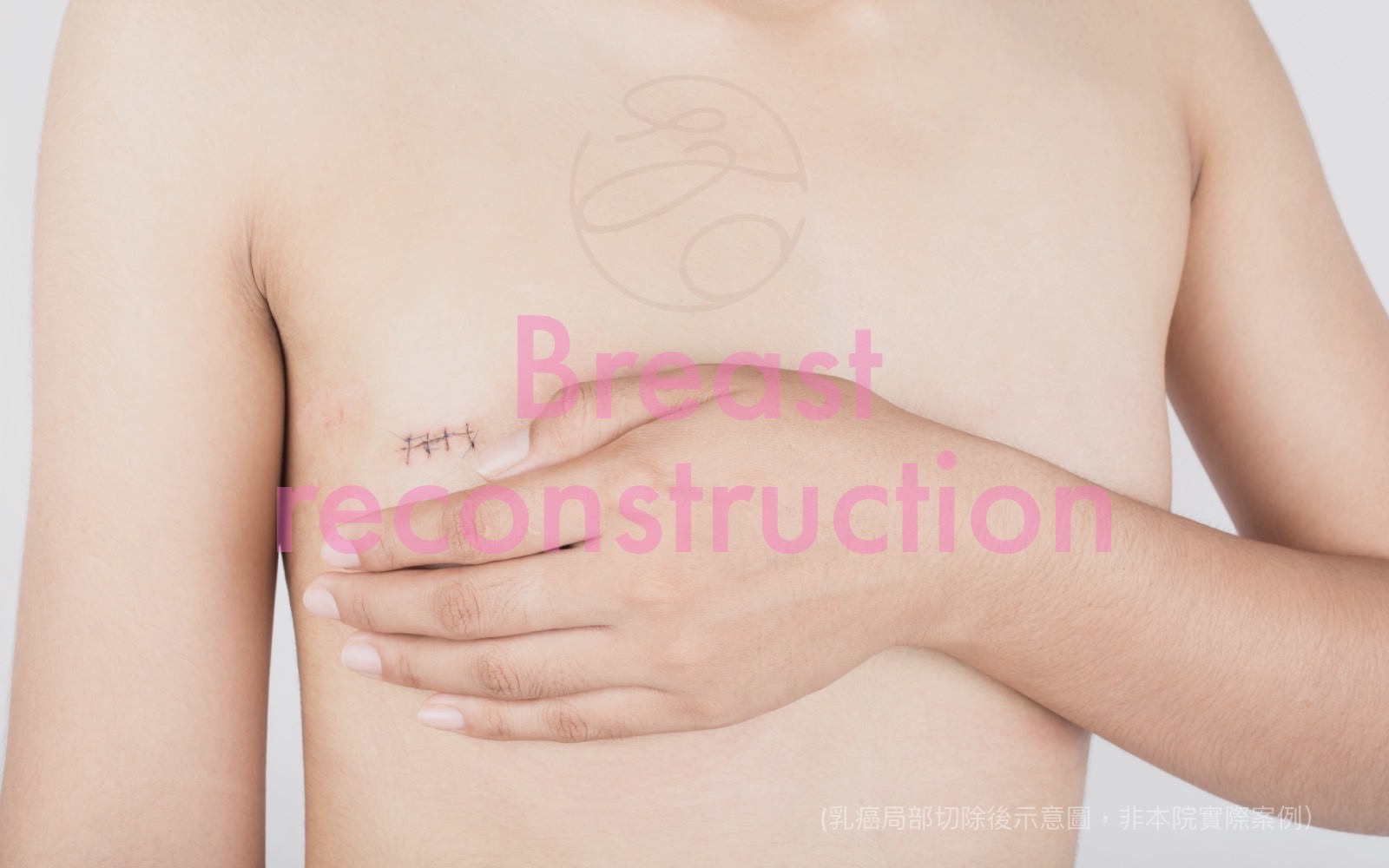 局部切除後的乳房重建手術