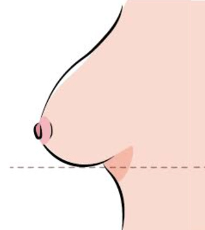 乳房下垂第一級