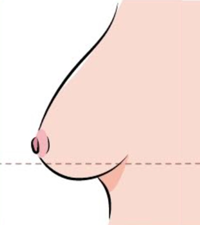 乳房下垂第二級