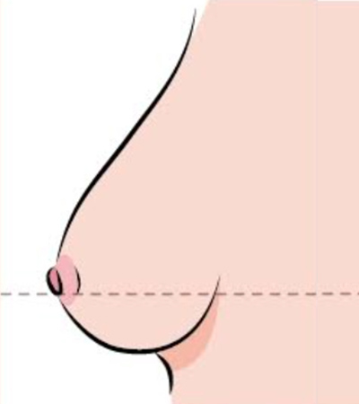 乳房下垂第三級