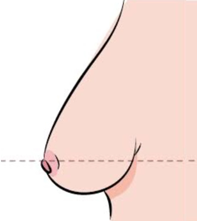 乳房下垂第四級