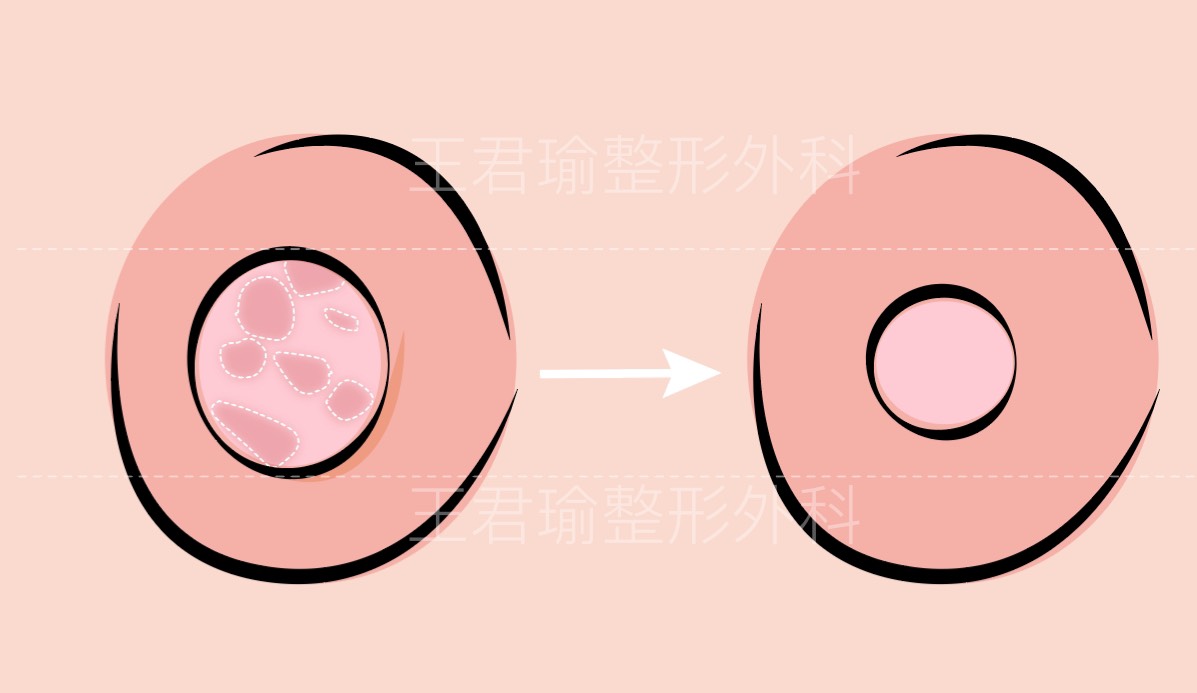 粉紅乳頭手術合併縮乳頭手術示意圖一