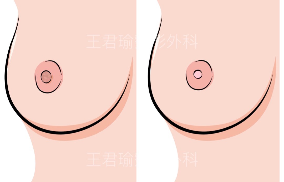 粉紅乳頭手術合併縮乳頭手術示意圖二