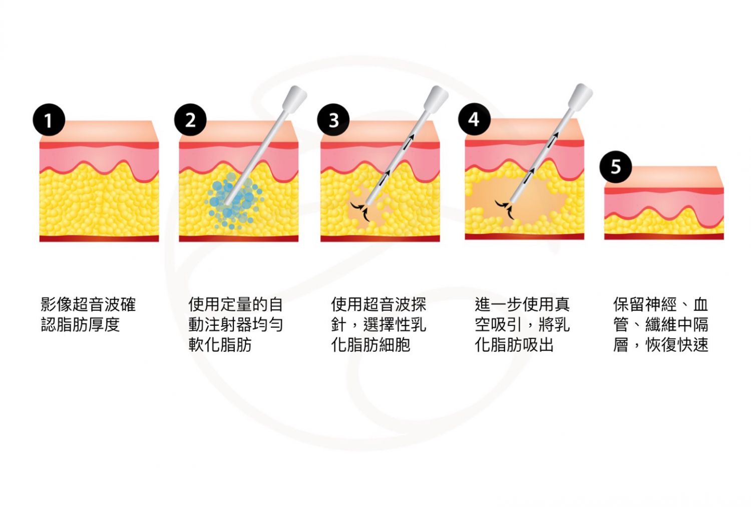 威塑VASER超音波抽脂手術步驟