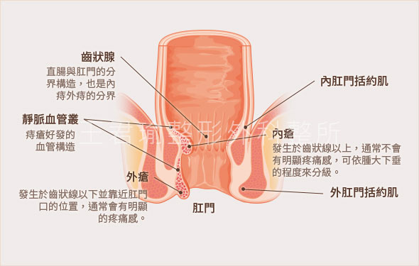 痔瘡的成因